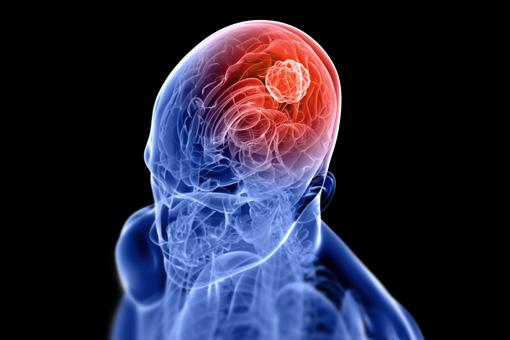 Giornata contro l'Ictus Cerebrale: prevenzione e supporto 