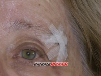 Anziana inciampa in un tombino sporgente, omero fratturato e ferita in faccia