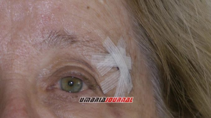 Anziana inciampa in un tombino sporgente, omero fratturato e ferita in faccia