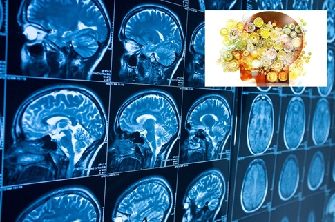 Ospedale Foligno, prestigiosa indagine nazionale sulla neuroriabilitazione