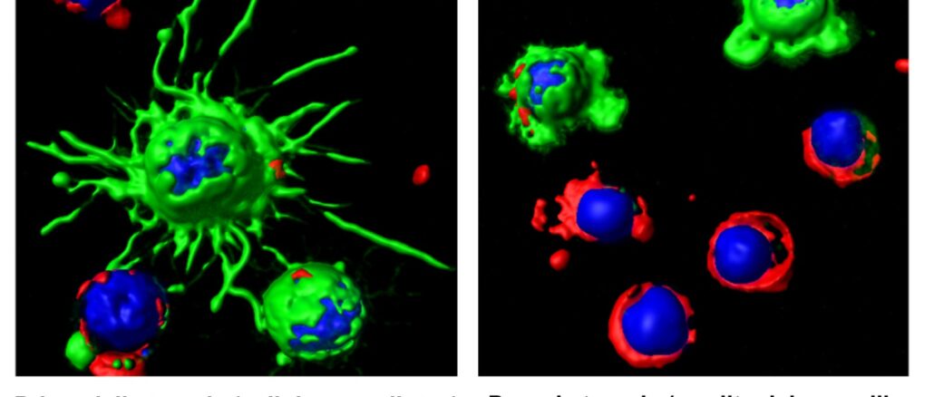 Nuova rivoluzionaria terapia contro la leucemia a cellule capellute