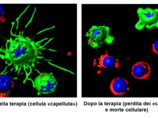 Nuova rivoluzionaria terapia contro la leucemia a cellule capellute