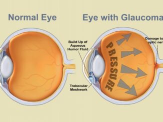 In Umbria circa 8mila persone sono colpite da glaucoma