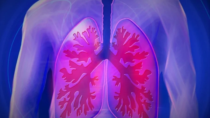 Covid: mutazione genetica che causa fibrosi cistica possibile scudo, studio
