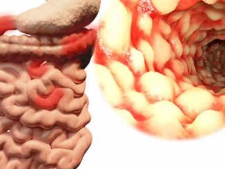 Malattia di Crohn, primo ok Ema per farmaco inibitore di Il-23