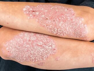 Farmaci, Bms, dati positivi da studio a 2 anni su anti-psoriasi orale