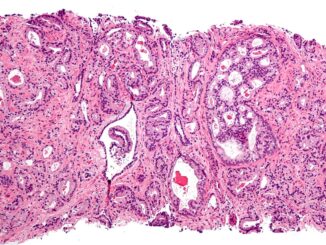 Carcinoma prostatico, terapia e diagnosi mirate su cellule maligne