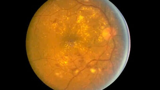 Rizzo (Gemelli), 'retinopatia diabetica sempre più frequente'