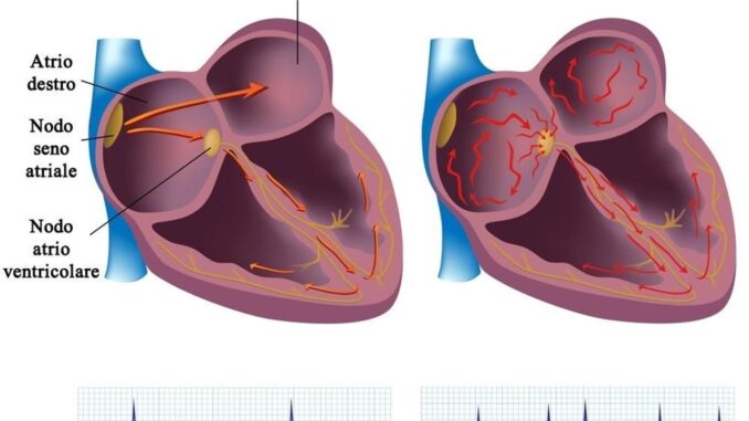 Radiazioni anticancro curano il 'cuore matto', studio Irccs Negrar 