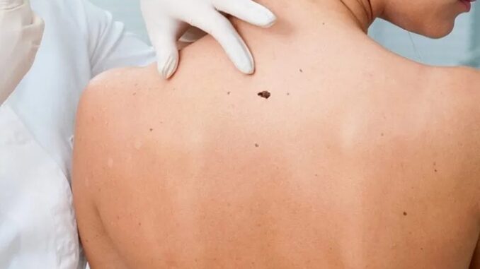 Melanoma: buoni risultati da mix vaccino e immunoterapia