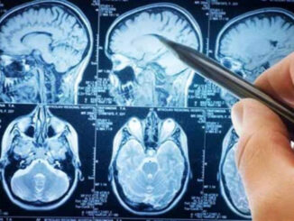 Sclerosi multipla: nuovo anticorpo frena la patologia