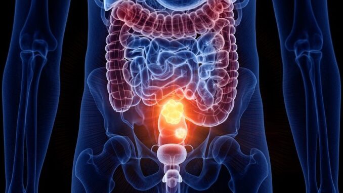 Batteri scoperti come complici nel cancro del colon-retto