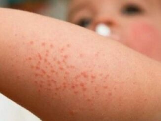 Casi scabbia aumentano in Uk, dermatologi situazione da incubo 