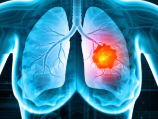 Nuova terapia per tumore polmone: AIFA autorizza farmaco lorlatinib