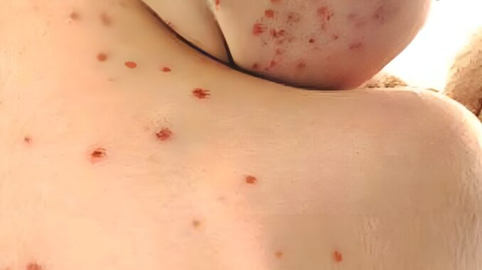 Morbillo poca igiene e calo vaccinazioni dietro aumento casi