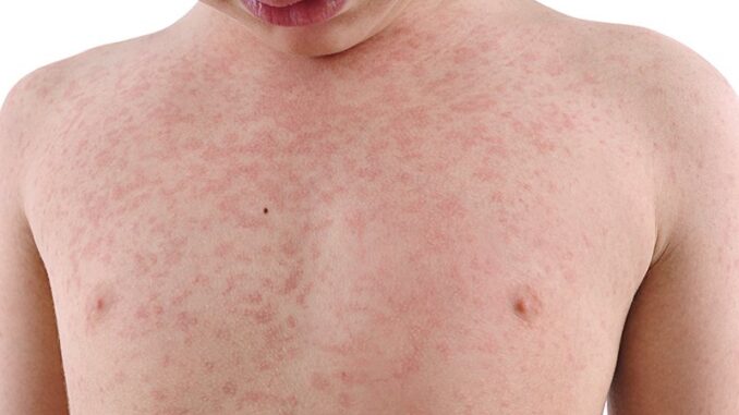 Morbillo, il virus dimenticato torna a far parlare di sé. La situazione