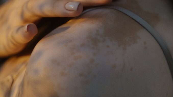 Vitiligine malattia sottovalutata dal Sistema sanitario nazionale