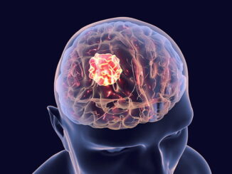 Scoperto Nuovo Meccanismo Immunosoppressore nel Glioblastoma