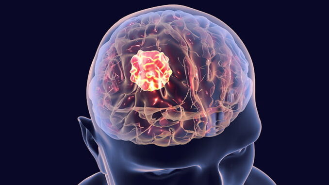 Scoperto Nuovo Meccanismo Immunosoppressore nel Glioblastoma