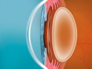 Lenti ICL: Una rivoluzione nella correzione dei difetti visivi