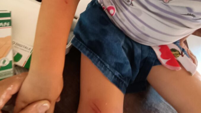 Ramo cade su bambina mentre va sull'altalena