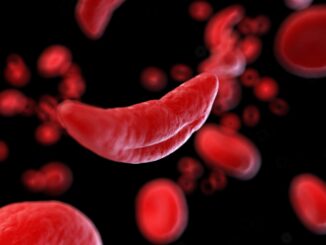Terapia genica innovativa per l'anemia falciforme a Perugia