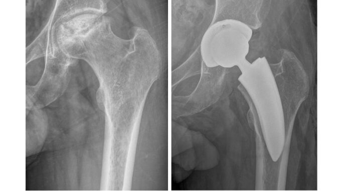 Ospedale di Perugia guida la svolta nelle protesi d’anca