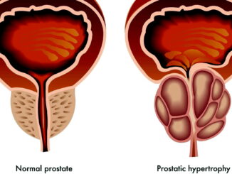 Ipertrofia prostatica: oltre 10 mila uomini convivono con i sintomi